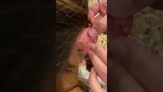 Infected Ear Piercing …