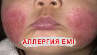 Аллергия емі