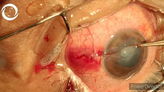 Corneoscleral tear repair under LA