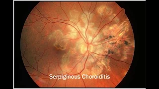 White dot syndromes - An Introductory tutorial