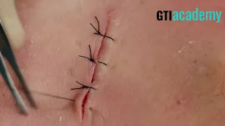 Suture Series | Simple Interrupted Suture