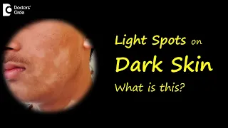 LIGHT SPOTS & PATCHES ON BROWN OR DARK SKIN? Causes & Treatment - Dr.Nischal K | Doctors' Circle