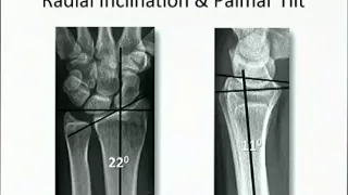 Distal Radius fracture