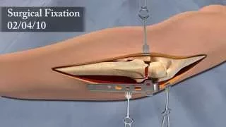 3D Surgical Animation of Elbow Injury