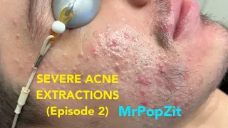 Severe Acne Extractions episode 2. Shrapnel pops! The saga continues! Part 2 of 3. So many pops!