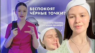 КАК УБРАТЬ ЧЕРНЫЕ ТОЧКИ // моя домашняя чистка