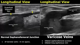 Saphenous Vein Doppler Ultrasound Normal Vs Abnormal | Varicose Veins | Lower Limb Vascular USG