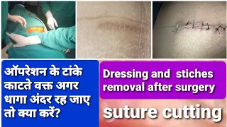 ऑपरेशन के टांके किस तरह से काटे जाते हैं ? types of sutures and stiches removal and Dressing