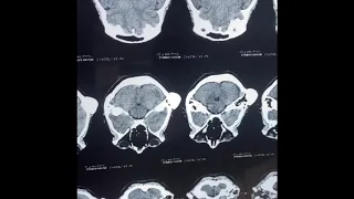 Mastoid Osteoma