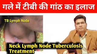 What are Cervical Tuberculosis Cause Symptoms and Treatment |  | टीबी की गांठ