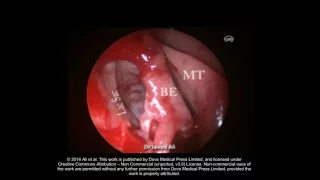 Endoscopic DCR in lacrimal sac within ethmoid sinus video-Abstract 108634