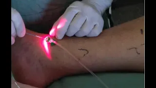 Remoção de Tatuagem sem dor, totalmente anestesiada