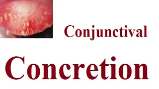 Conjunctival Concretions