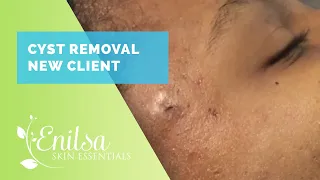 Cyst Removal New Client