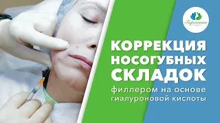 Коррекция носогубных складок филлером на основе гиалуроновой кислоты