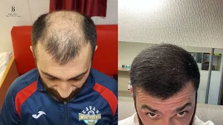 Amazing Hair Transplant Result -  Large baldness fully restored
