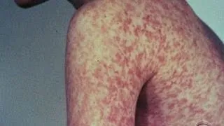 Measles is making a comeback in U.S.