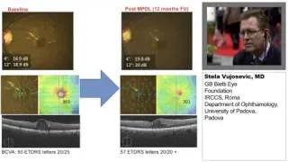 Principles of Subthreshold MicroPulse Laser Therapy for Retinal Disorders