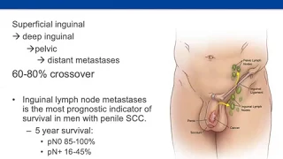 "Lymph Nodes in Advanced Penile Cancer" and "Minimally Invasive Treatment Options for BPH"