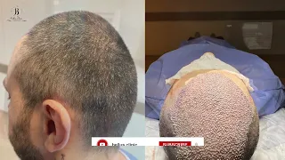 пересадка волос  в Bellus clinic