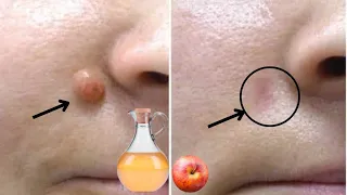 APPLE VINEGAR removes WARTS in 24 HOURS! This is what you need to do...