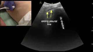 Lung Ultrasound, Scanning Techniques