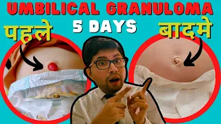 Umbilical Granuloma | नवजात शिशु की नाभि से बार बार खून आना केसे बंध करे |