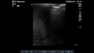 Case 63 : Inguinal lymph node abscess