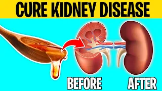 No KIDNEY Patient Will Ever Lose a Kidney Again, Watch This