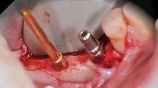 MegaGen Implants AnyRidge Surgical Protocol  Video