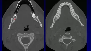 Neck Infections 1