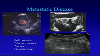 Ultrasound Postmenopausal Pelvis