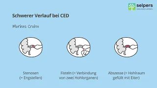 Schwerer Verlauf bei Morbus Crohn und Colitis ulcerosa - was sind mögliche Komplikationen?