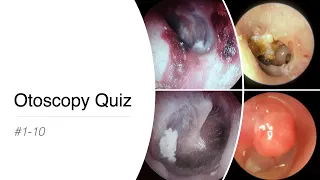 Otoscopy Quiz #1 - 10