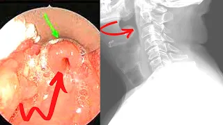 Epiglottitis (Emergency) Symptoms, Causes, Treatment