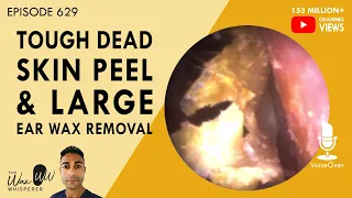 629 - Tough Dead Skin Peel & Large Ear Wax Removal