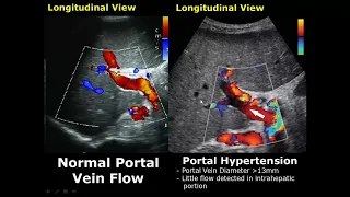 Liver Ultrasound Normal Vs Abnormal Image Appearances Comparison | Liver Pathologies USG