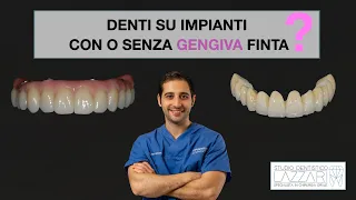 Denti su impianti con o senza gengiva finta?