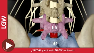 L5-S1 Posterior Lumbar Interbody Fusion 3D Animation