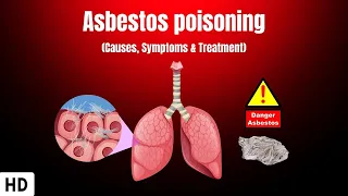 Asbestos Poisoning: Causes, Symptoms and Treatment