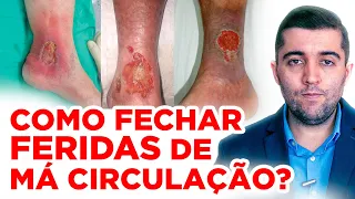 Como acabar com úlceras/feridas da má circulação: curativo, antibiótico, diagnóstico e cicatrização