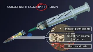 PRP Therapy For Men || E.3