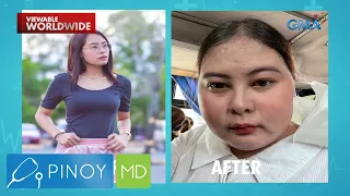 Paglobo ng katawan ng isang dalaga, epekto raw ng gamot sa pananakit ng ulo?! | Pinoy MD