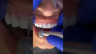 #dentist Removing temporary smile NOT actual teeth #temporarysmile #ASMR #dental