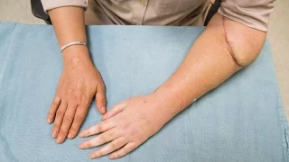 Canada's first hand transplant patient shares her experience