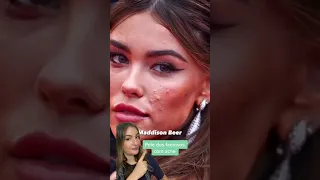 Acne nos famosos