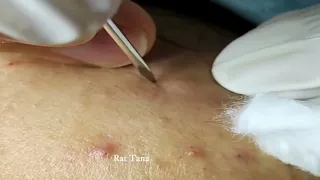 Acne treatment   acne removal   acne blackheads whiteheads removal 8980