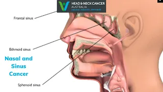 Nasal and Sinus Cancer - What Is It? What are the Symptoms and Treatment? Head and Neck Cancer