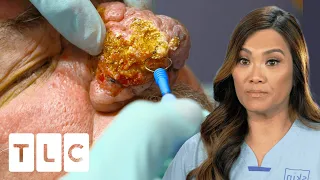 Dr. Lee Transforms Patient's Hugely Overgrown Nose I Dr. Pimple Popper: Pop Ups