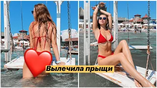 КАК Я ВЫЛЕЧИЛА ПРЫЩИ? РАССКАЗЫВАЮ СВОЙ ОПЫТ || КАК ДЕЛАЮТСЯ ФОТОЧКИ В ИНСТА 😅